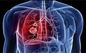 Hipertensão Pulmonar: campanha nacional pretende aumentar qualidade de vida de doentes e cuidadores