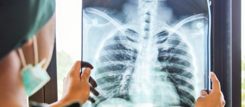 fibrose pulmonar dr